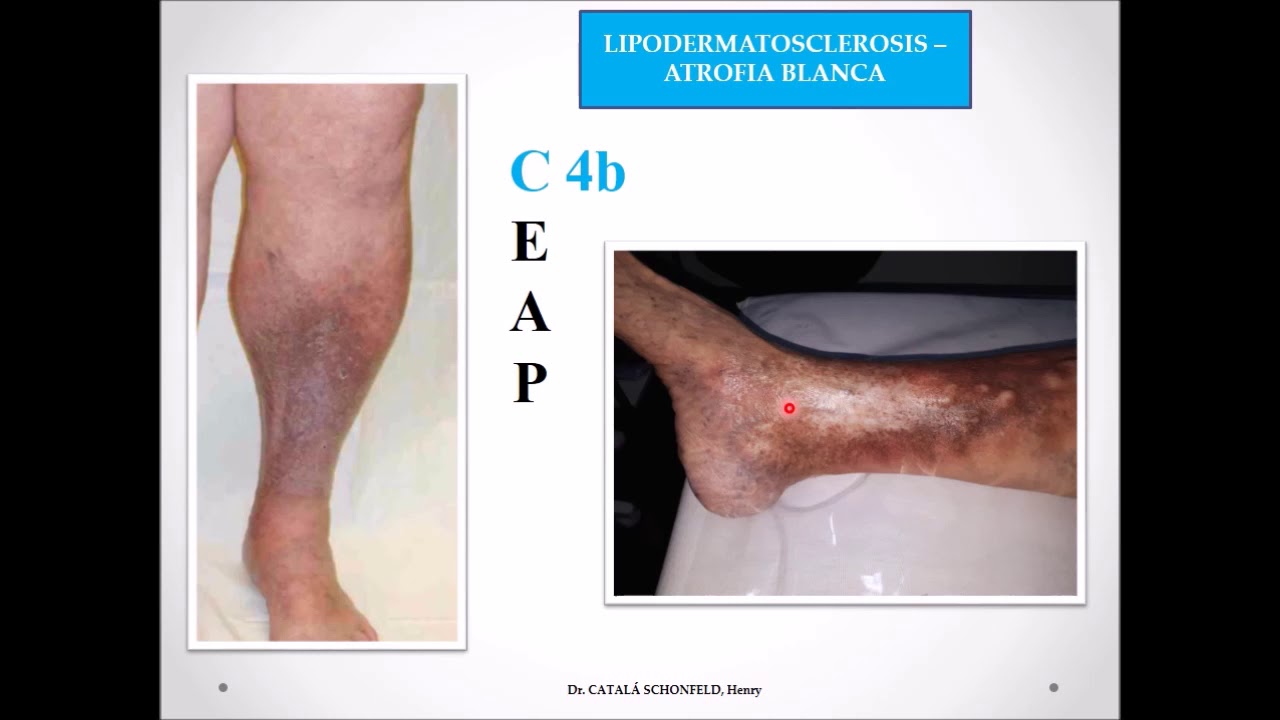 Insuficiencia venosa. Resumen en 2 min. YouTube Insuficiencia venosa. Resumen en 2 min. YouTube