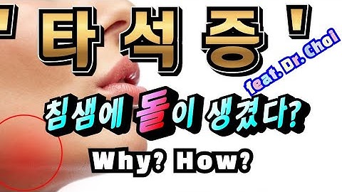 타석증- 침샘에 돌이 생겼다고요? Why? How? 갑자기 침샘이 붓는다면 꼭 보세요?