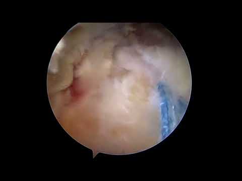 Réparation de coiffe arthroscopique Testing de solidité - Dr Falcone Clinique Jouvenet