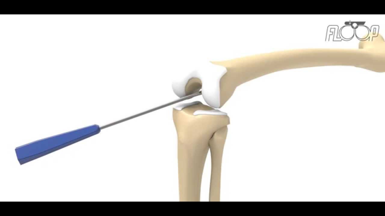 South America Implants S.A. - DC-525-00 FLOOP RODILLA