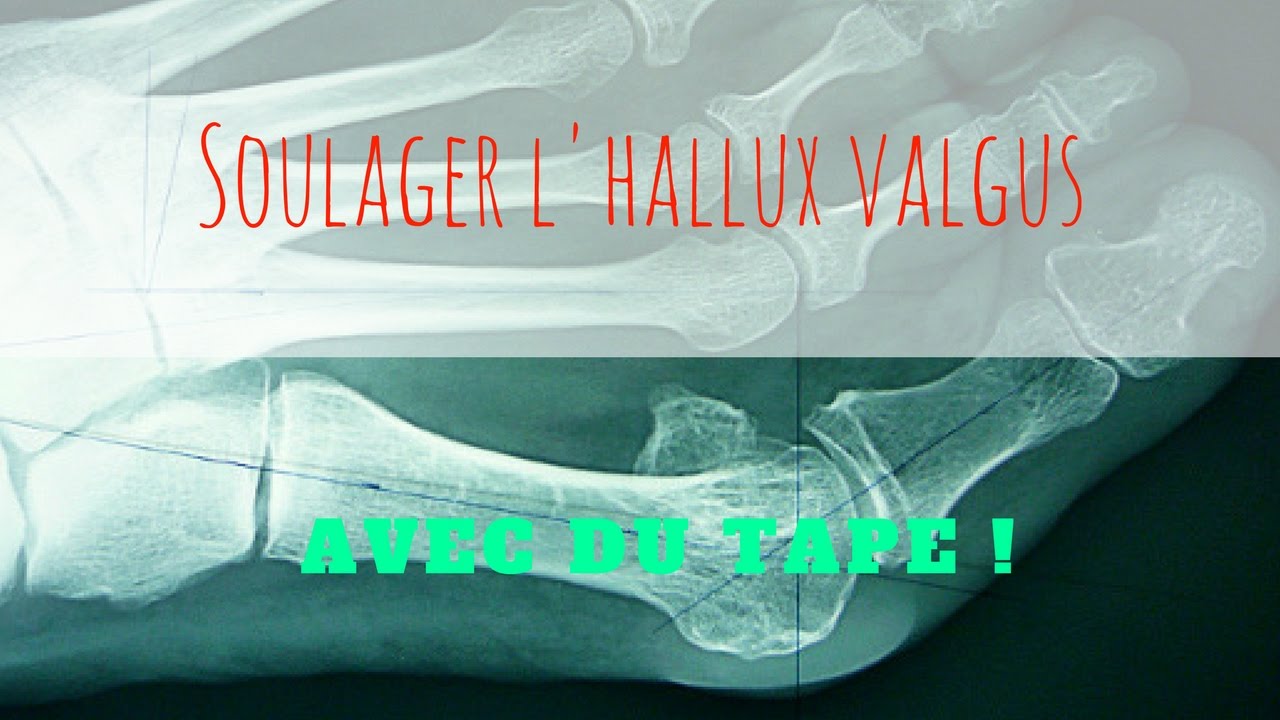 Soulager un Hallux valgux avec du K-Tape !