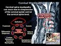 Cervical Myelopathy - Everything You Need To Know - Dr. Nabil Ebraheim