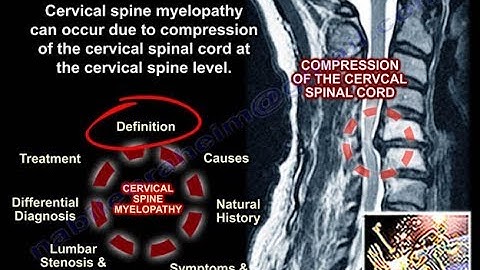 Cervical Myelopathy - Everything You Need To Know - Dr. Nabil Ebraheim