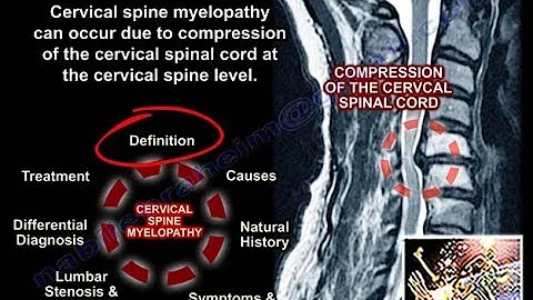 Cervical Myelopathy - Everything You Need To Know - Dr. Nabil Ebraheim