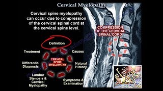 Cervical Myelopathy  Everything You Need To Know  Dr. Nabil Ebraheim