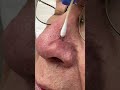 Let S Get That Thing Out Dr Derm Let S Get That Thing Out Dr Derm