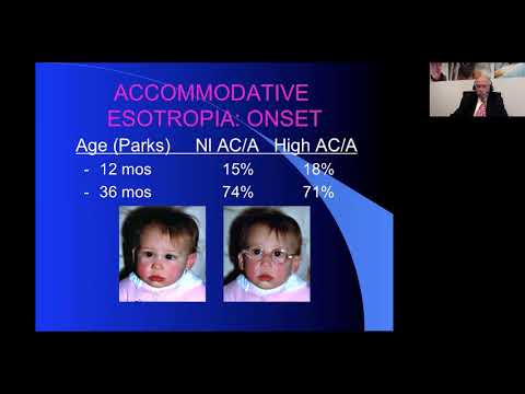 Accommodative Esotropia and its Complications