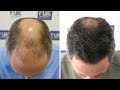 FUE Hair Transplant (3268 Grafts in NW V-VI) Dr. Juan Couto - FUEXPERT CLINIC- Madrid, Spain