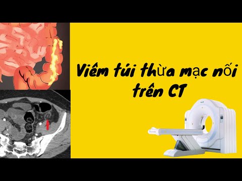 Video Cách dựng hình viêm túi thừa mạc nối trên CT - youtube