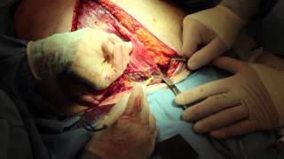 Live Surgery: Vertical Rectus Abdominis Muscle Flap (VRAM) for Sternal Wound