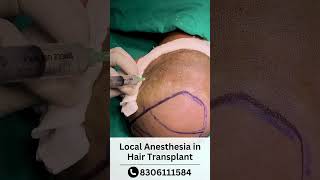 Local Anesthesia In Hair Transplant Local Anesthesia Injection Skinaa Clinic 