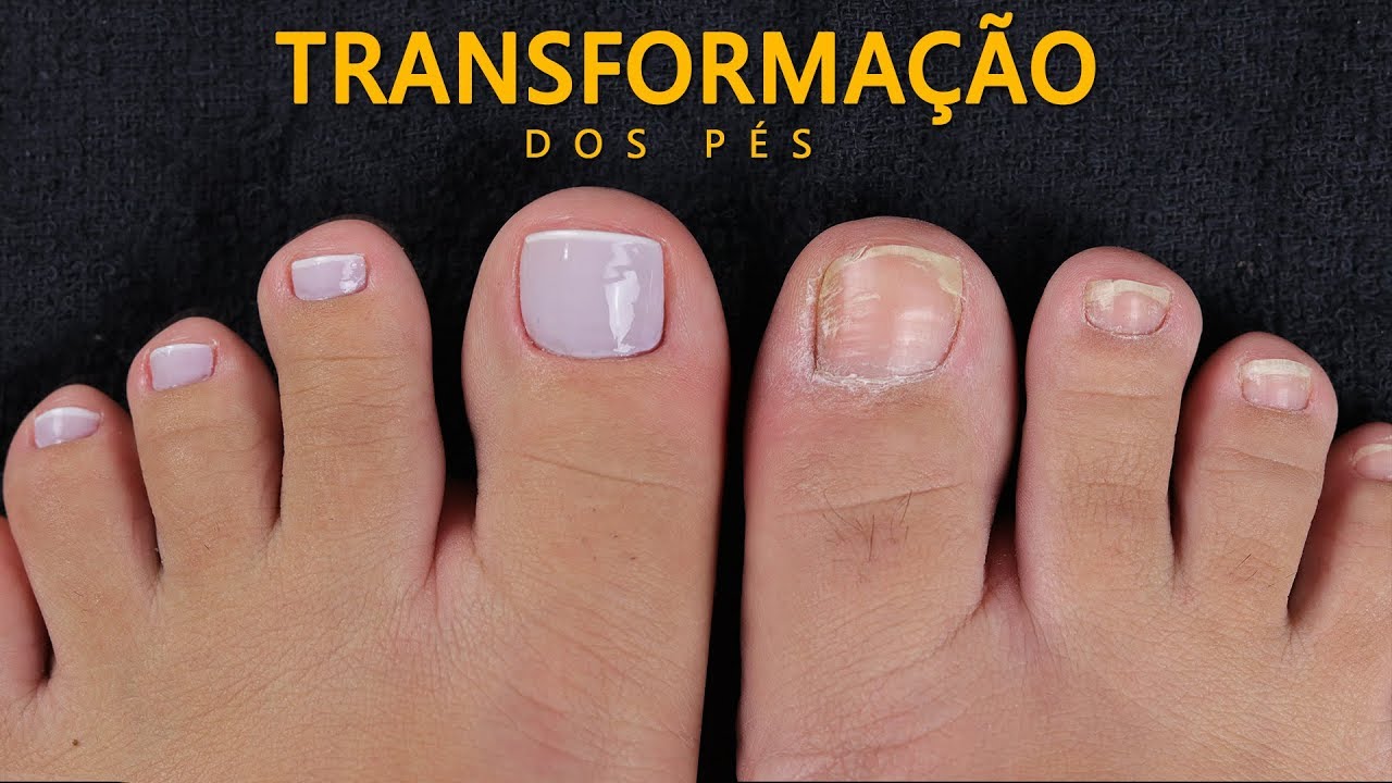 Cutilagem do pé, vídeo de transformação