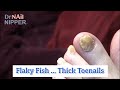 What Flaky Toenails for a Thick Fisherman? You betcha [Throwback Thursday]