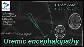 UREMIC ENCEPHALOPATHY# Lentiform fork sign# End renal disease# Umamaheshwar Reddy.V