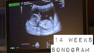 14 WEEKS PREGNANT ULTRASOUND\/SONOGRAM AND PICTURES 🤰🏽