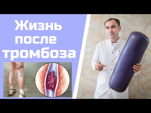 Посттромботическая болезнь. Как лечить. Флеболог Москва.