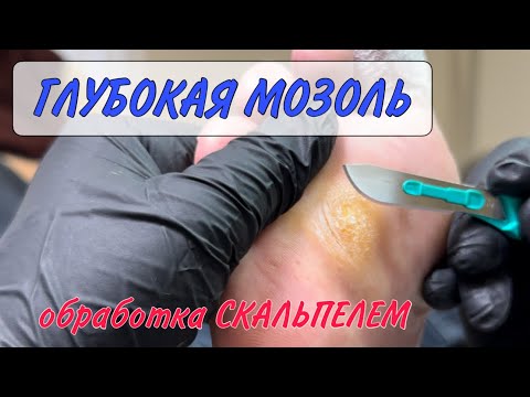 🥕МОЗОЛЬ на ноге / как убрать мозоль / курсы подологии