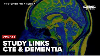 New developments: Researchers find severe CTE causes dementia