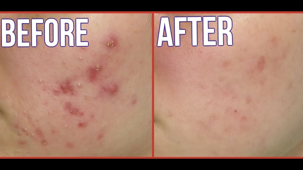 My Experience and Results on Accutane