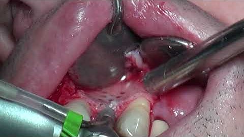 Lateral Bone Augmentation & Implant Placement - Double Layer Technique (Allograft, Collagen Memb.)