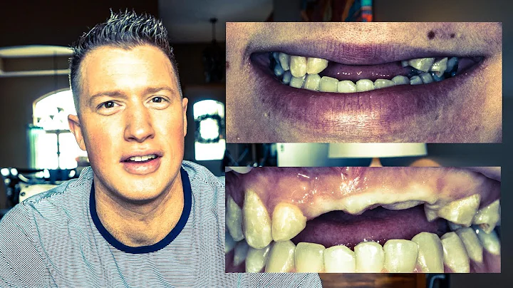 ATV WRECK leaves lady TOOTHLESS! COSMETIC DENTISTRY DENTAL IMPLANTS & VENEERS (EP 2 SMILE MAKEOVER)