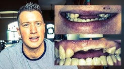 ATV WRECK leaves lady TOOTHLESS! COSMETIC DENTISTRY DENTAL IMPLANTS & VENEERS (EP 2 SMILE MAKEOVER) 