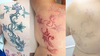 Laser Tattoo Removal - Full Process