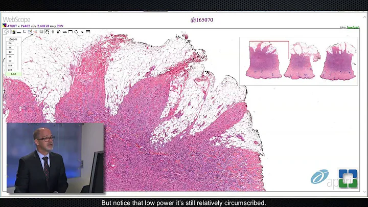 Pathology Insights: Challenging Cutaneous Spindle ...