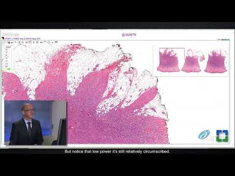 Pathology Insights: Challenging Cutaneous Spindle Cell Tumors with Steven Billings, MD