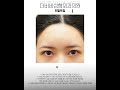#더비비성형외과 답답하게 올라간 눈꼬리를 내려 선하고 시원한 눈매를 완성