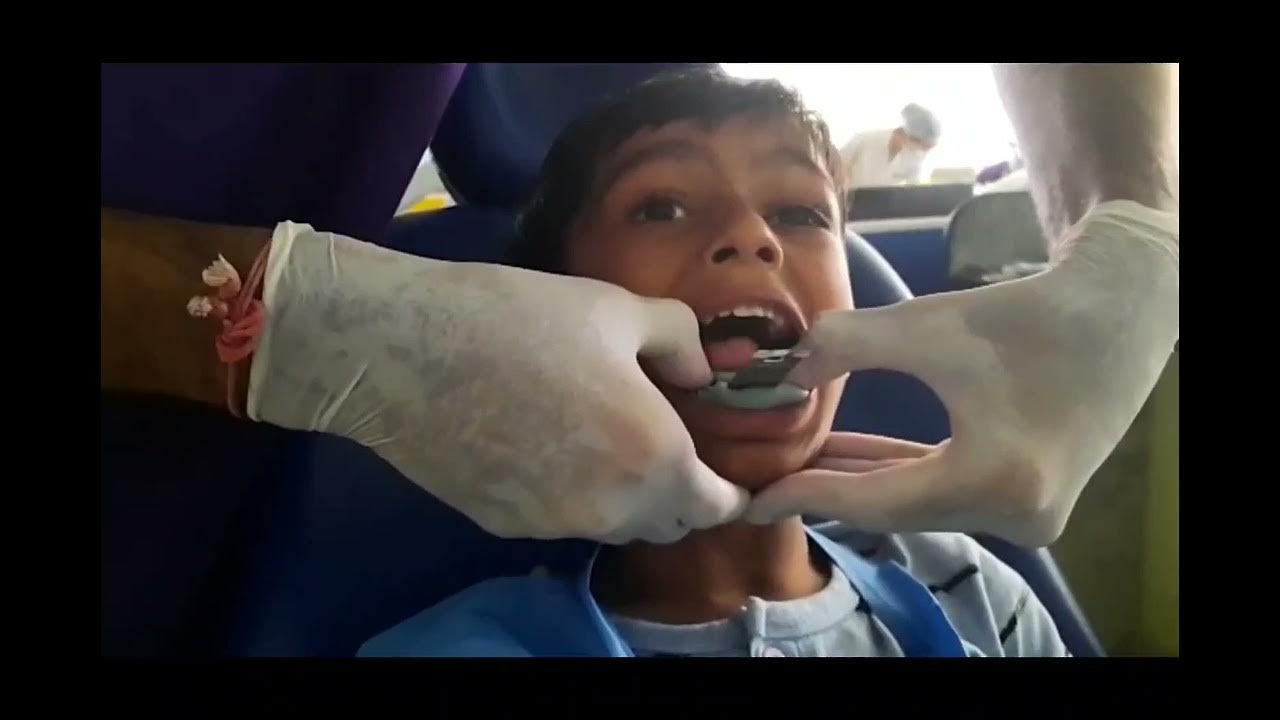 Elastomeric Impression Technique YouTube