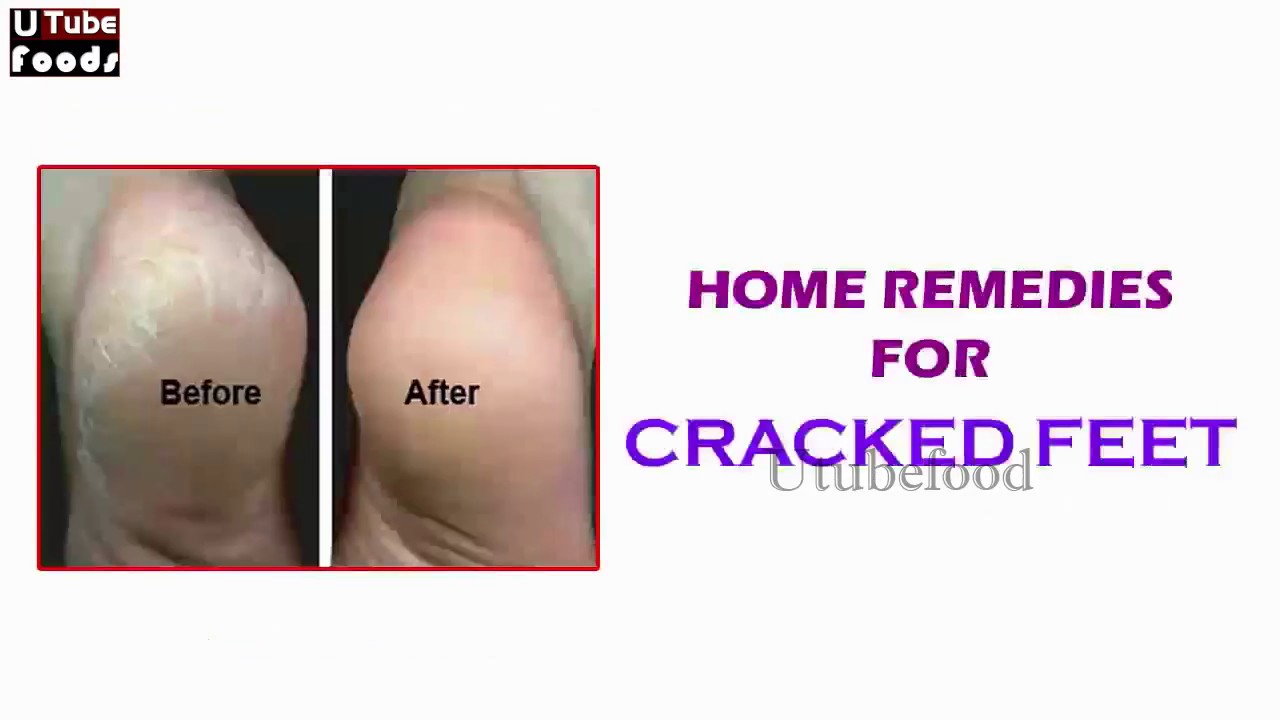 ひび割れしたかかとのホームの治療法 治療のひどい足の速さ Youtube