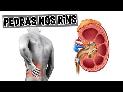 Vídeo: Dieta Para Urolitíase