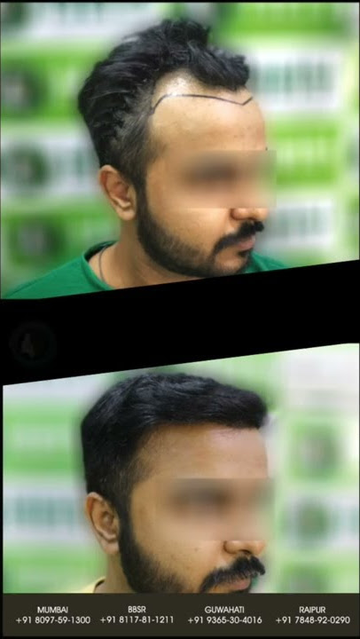 Book your hair consultation today @ https://www.hhy.co.in/
