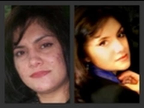 remedios maternity quitar cicatrices de acne