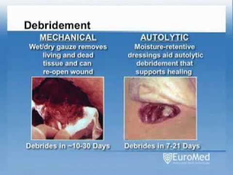 Vidéo: Débridement: Types, Récupération, Complications Et Plus