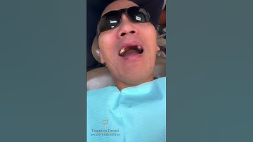 TITANIUM Dental - Front Implant Bridge  #dentist #dentalimplant #smile