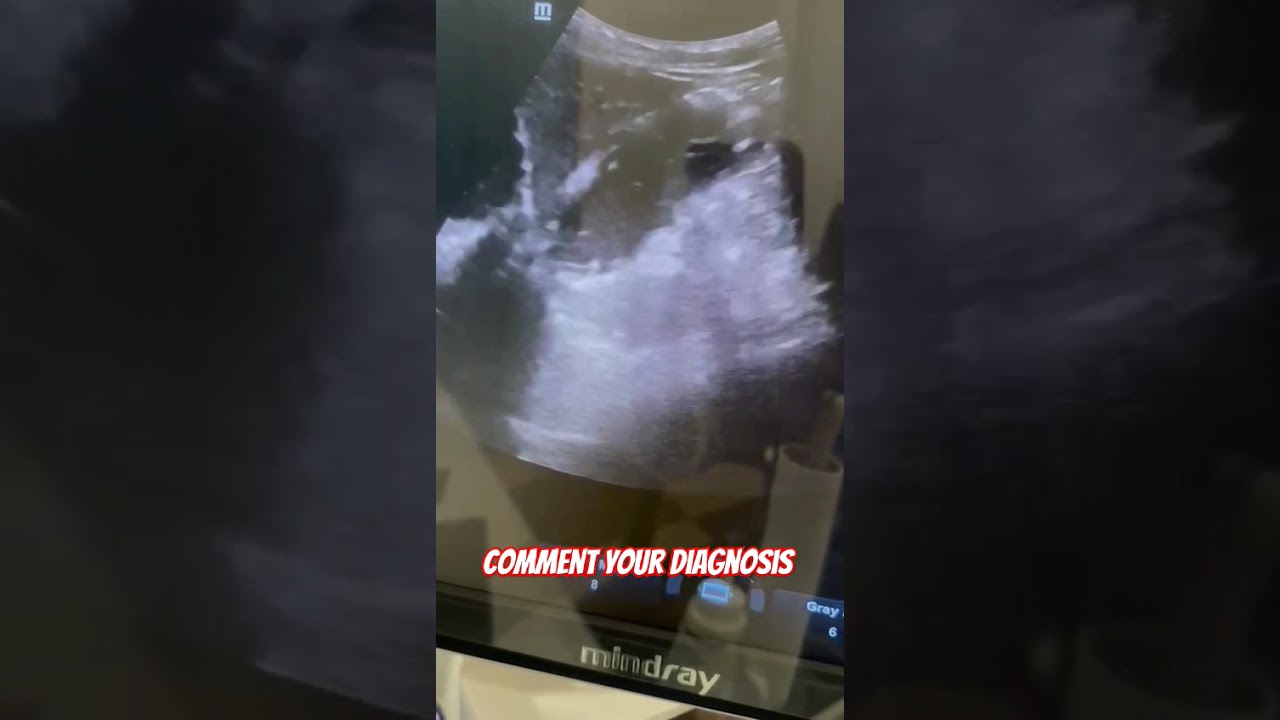 imaging case 17.A 7y old male with hx of stomach pain. Dr ?gastritis #ultrasound #medicalimaging