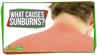What Causes Sunburns?