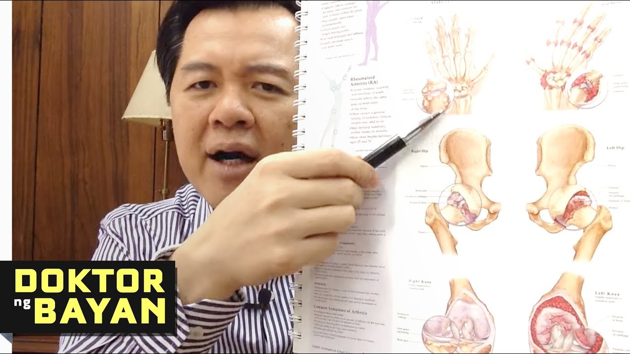 ARTHRITIS (Osteo-arthritis) – Payo ni Dr Willie Ong #88b