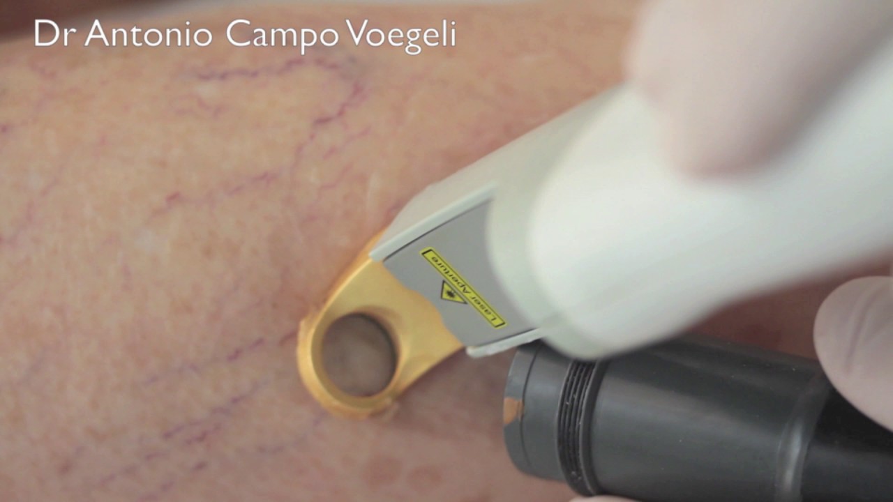 Vein treatment with Cutera's Excel V (1064nm).