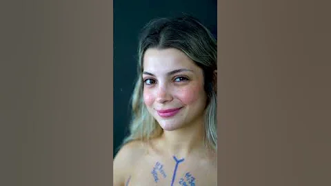 Impressive Results of Breast Augmentation Surgery! #breastimplantsurgery #vanitycosmeticsurgery