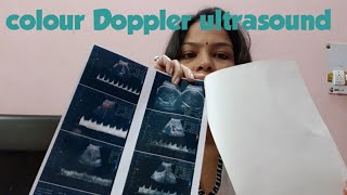 #Colourdopplerultrasound #ultrasound8month #why colour Doppler scan is important for pregnant women