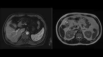 RCC and duodenal GIST
