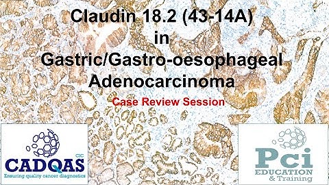 Case Review for PT 1231 CLDN18 2 IHC Interpretation in G:GEJ Adenocarcinoma 3Dec2025
