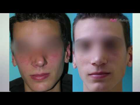 Vidéo: Stars avec une bosse sur le nez qui n'ont pas fait et ne veulent pas avoir de rhinoplastie