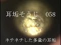 耳垢そうじ/耳がネチネチして痒い大量の耳垢/058