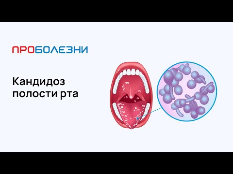 Видео: 3 способа борьбы с инфекцией полости рта