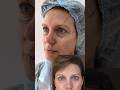 #липофилинг #височныйлифтинг #блефаропластика