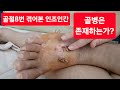 골병은 존재하는가? 오토바이 타다가 크게 다치면 진짜 골병 들까? 인조인간 무혁맨의 경험담